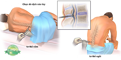 Đau đầu do chọc dò cột sống - Hình ảnh minh họa